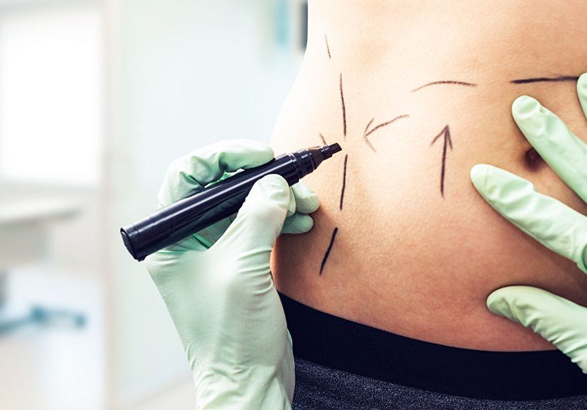 Marking the incision lines for surgical skin tightening