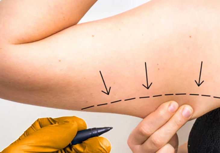 liposuktion-am-arm-lipocura