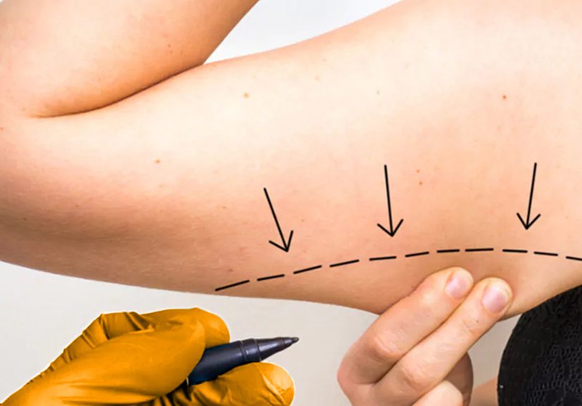 liposuktion-am-arm-lipocura